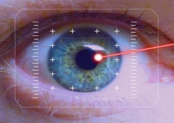 Cataratta: quando è meglio l’intervento tradizionale e quando la tecnologia laser assistita?