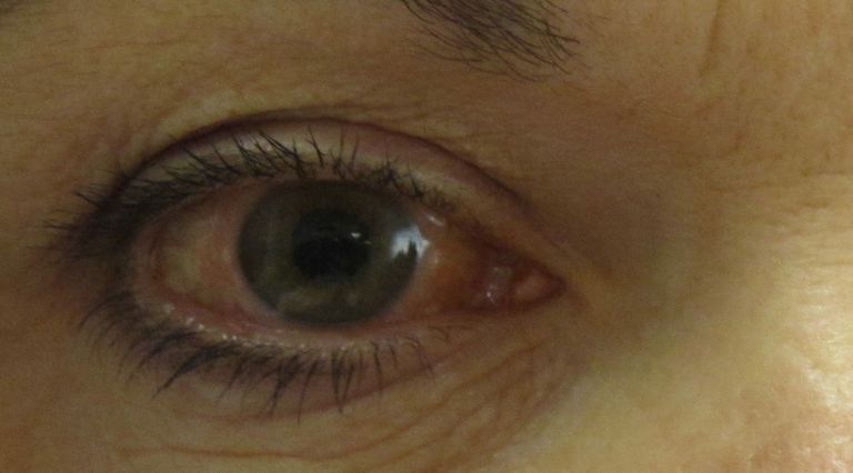 Glaucoma, quasi la metà dei malati al nervo ottico non segue la terapia